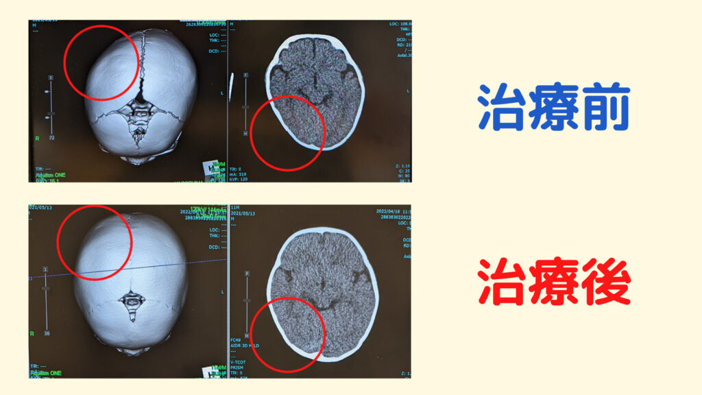 ヘルメット矯正の治療前と治療後の比較CT画像